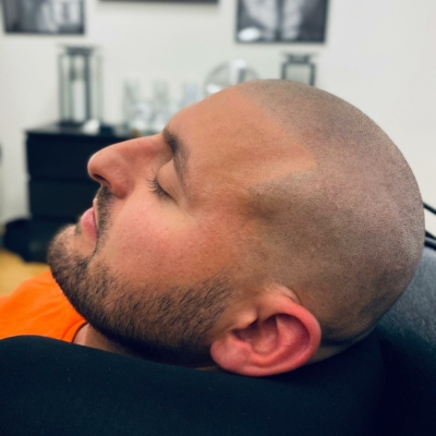 Scalp micropigmentation