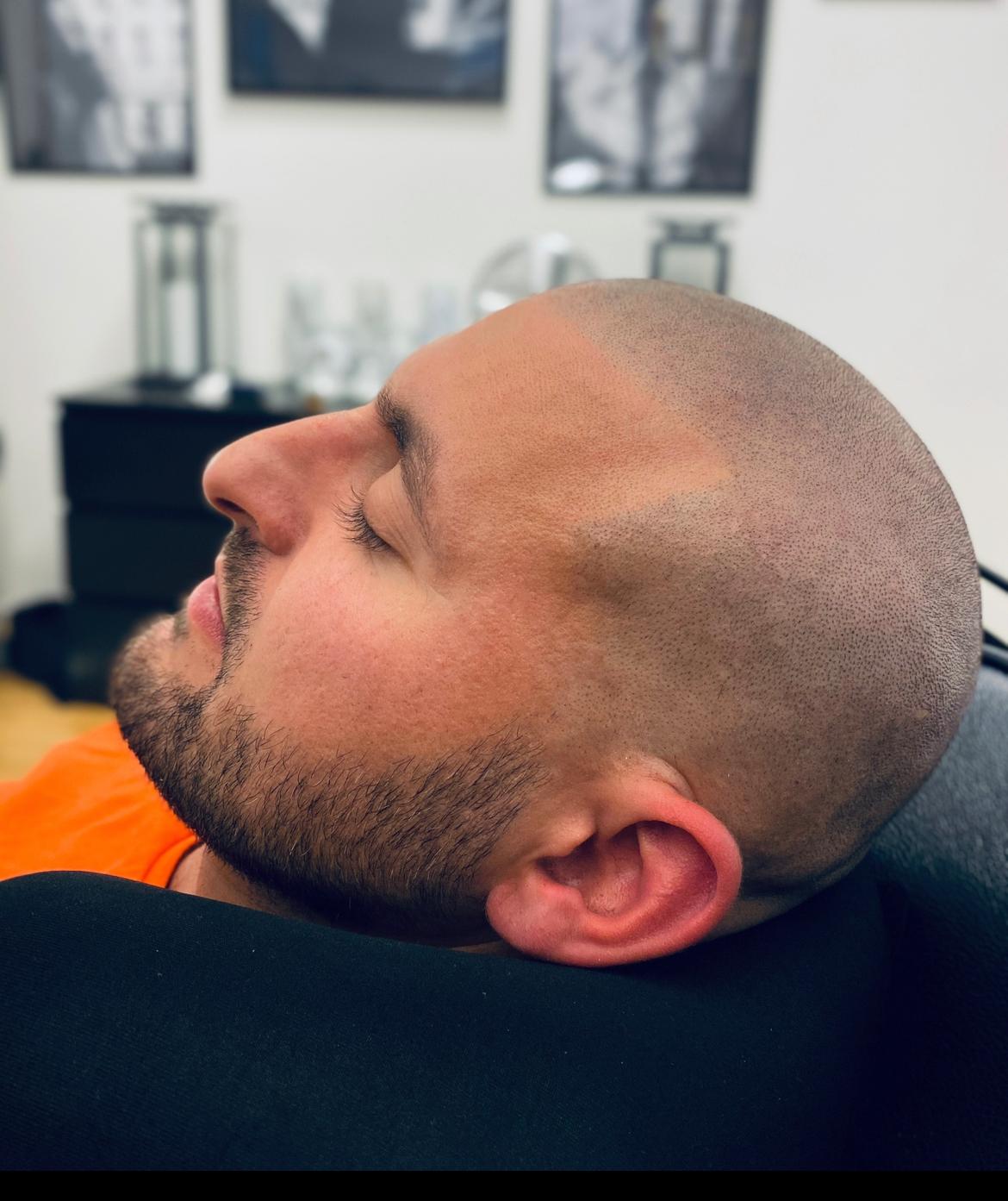 Scalp micropigmentation