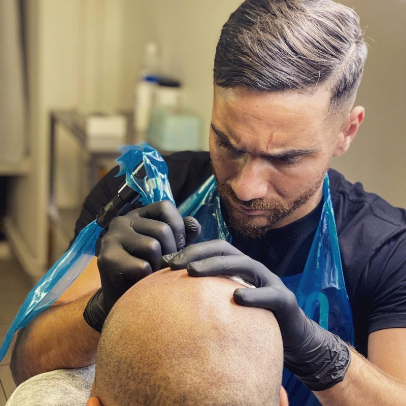 Scalp micropigmentation