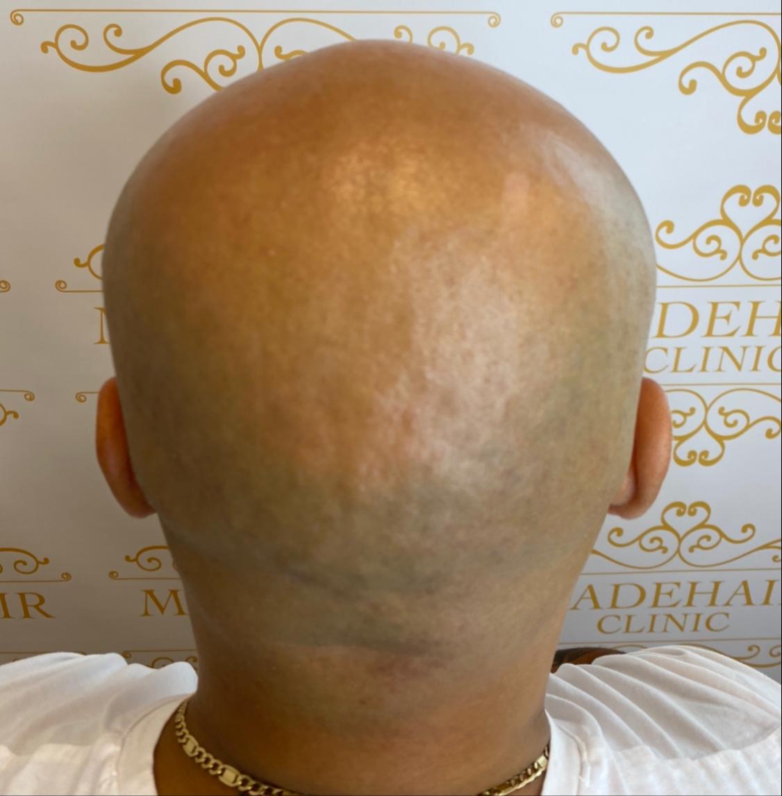 alopeci behandling