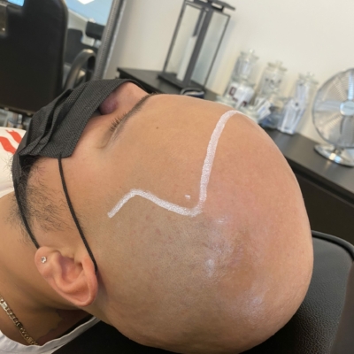 Scalp micropigmentation