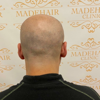 Permanent kamouflage ärr