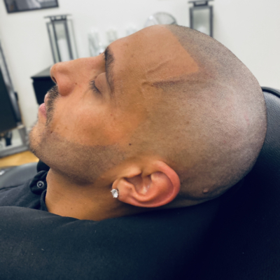 Scalp micropigmentation