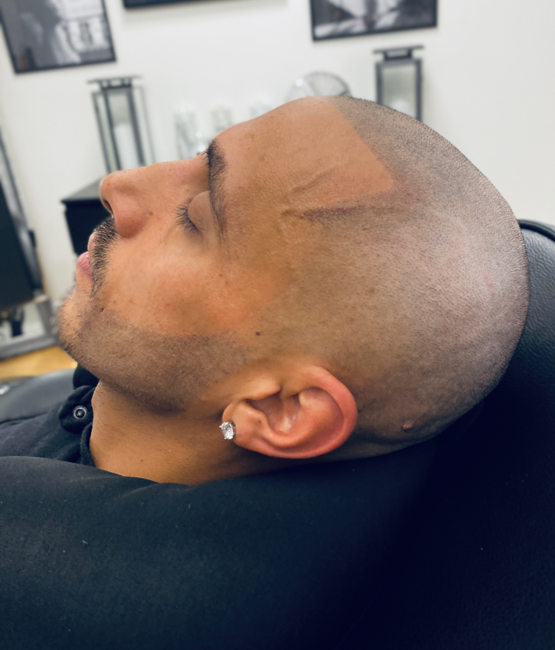 Scalp micropigmentation