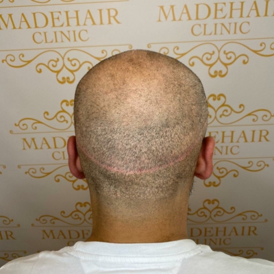 Permanent kamouflage ärr