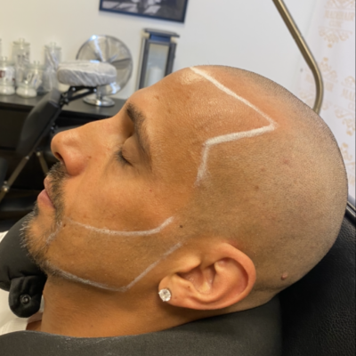 Scalp micropigmentation