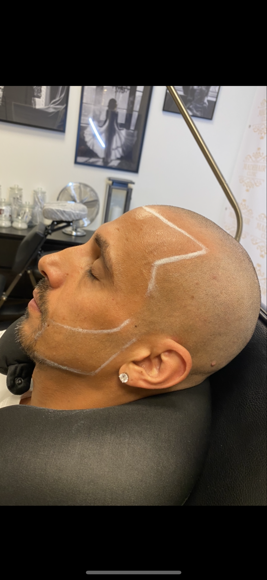 Scalp micropigmentation