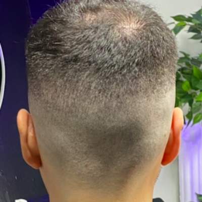 Permanent kamouflage ärr