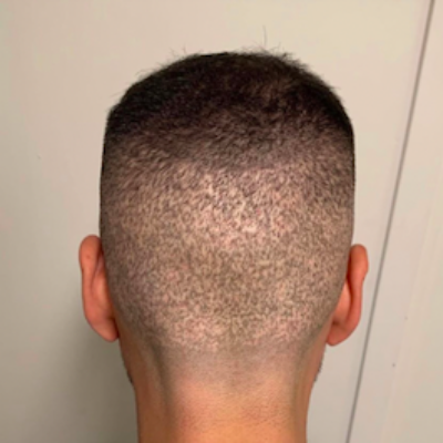 Permanent kamouflage ärr