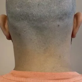 Scalp Micropigmentation, Hårpigmentering - Naturlig hårlinje med smp på man, 28 år, i Stockholm– Naturligt resultat från Made Hair Academy.