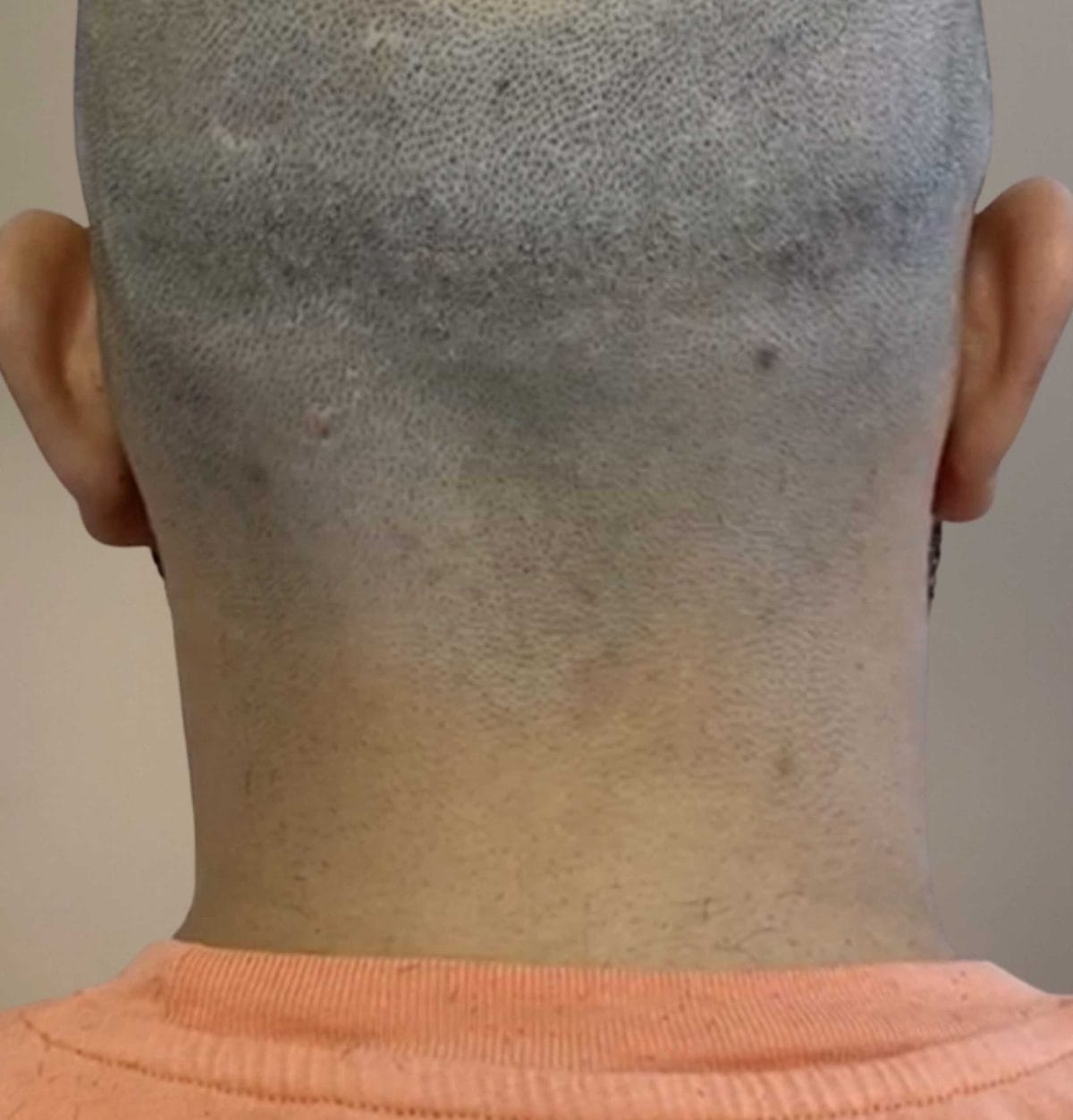 Scalp Micropigmentation, Hårpigmentering - Naturlig hårlinje med smp på man, 28 år, i Stockholm– Naturligt resultat från Made Hair Academy.