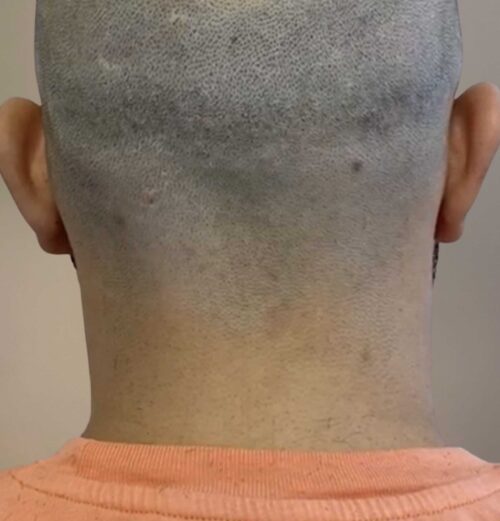 Scalp Micropigmentation, Hårpigmentering - Naturlig hårlinje med smp på man, 28 år, i Stockholm– Naturligt resultat från Made Hair Academy.