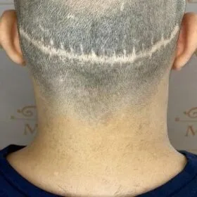 Diskret hårskuggning på man, 31 år, utförd hos Made Hair Academy Göteborg – ledande klinik för diskret hårtatuering i Sverige.