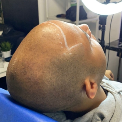 alopeci behandling