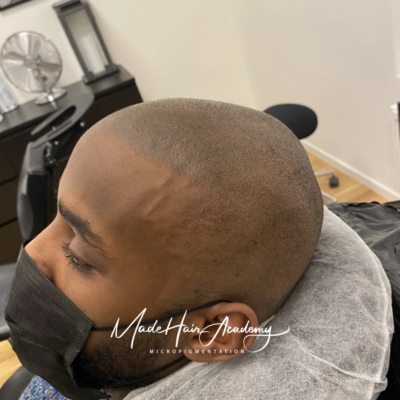 Scalp micropigmentation