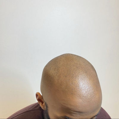 Scalp micropigmentation (före)
