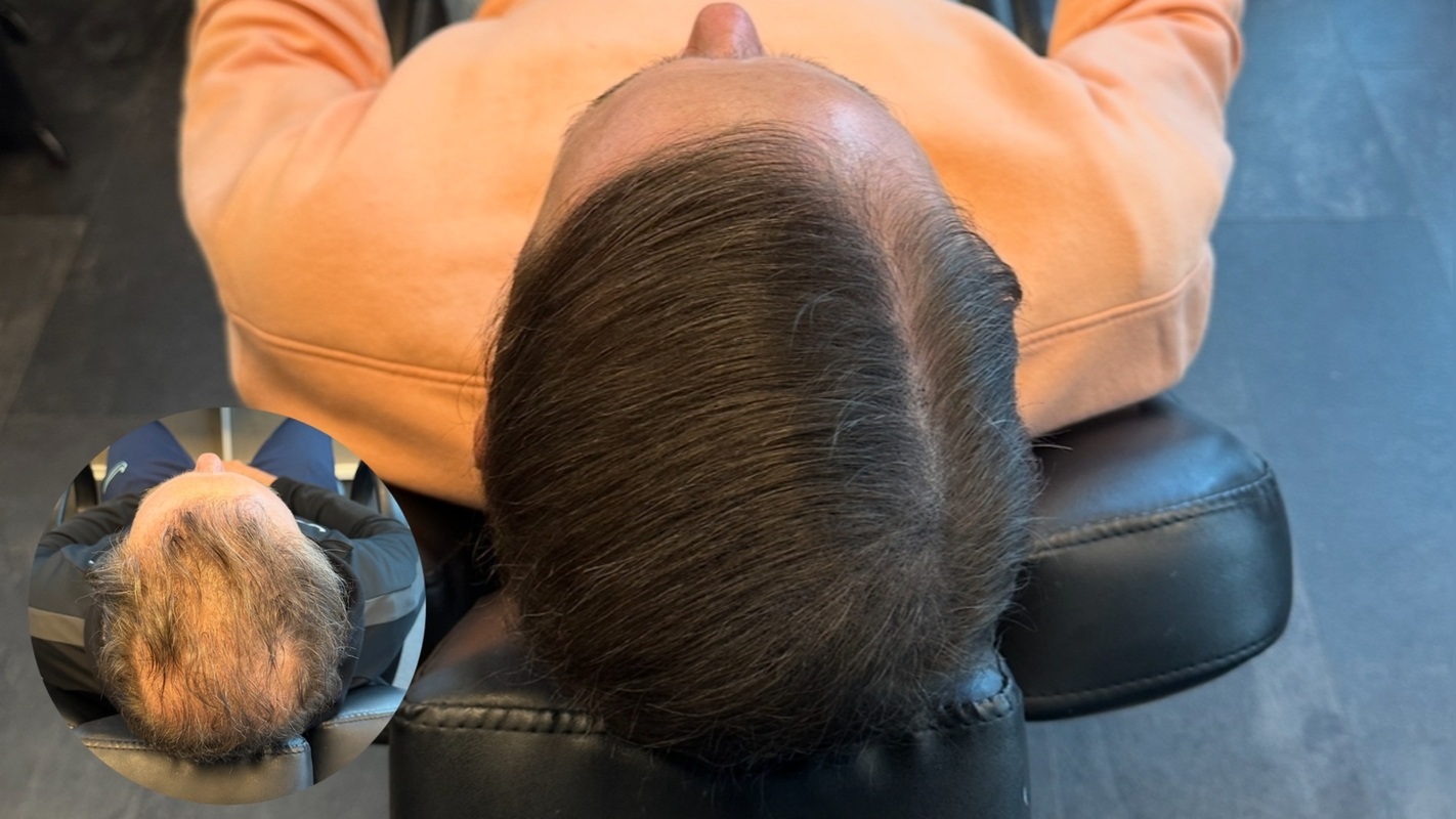 Resultat efter hårtransplantation förstärkt med hårpigmentering | Made Hair Academy – ledande i Sverige