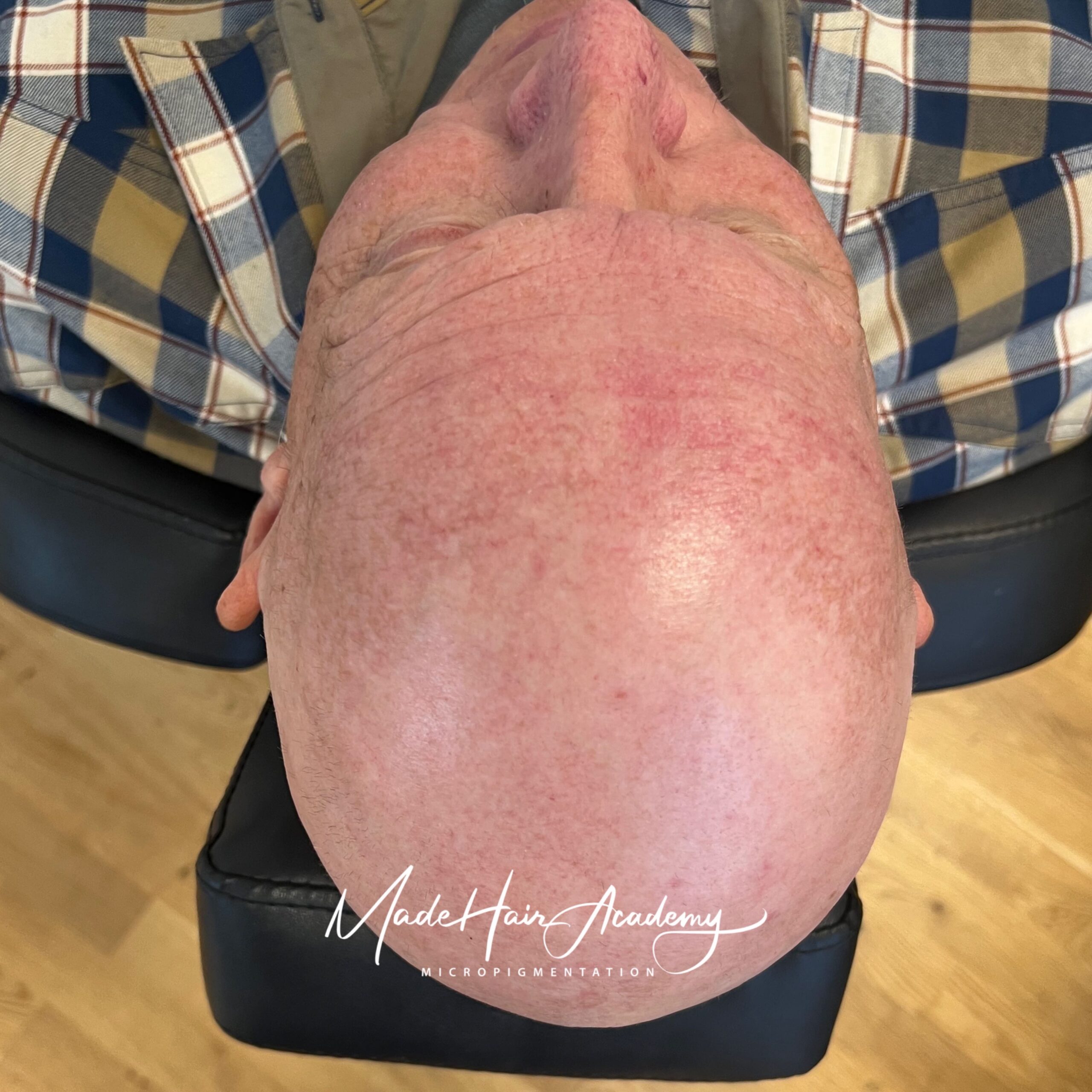 Alopecia totalis behandling