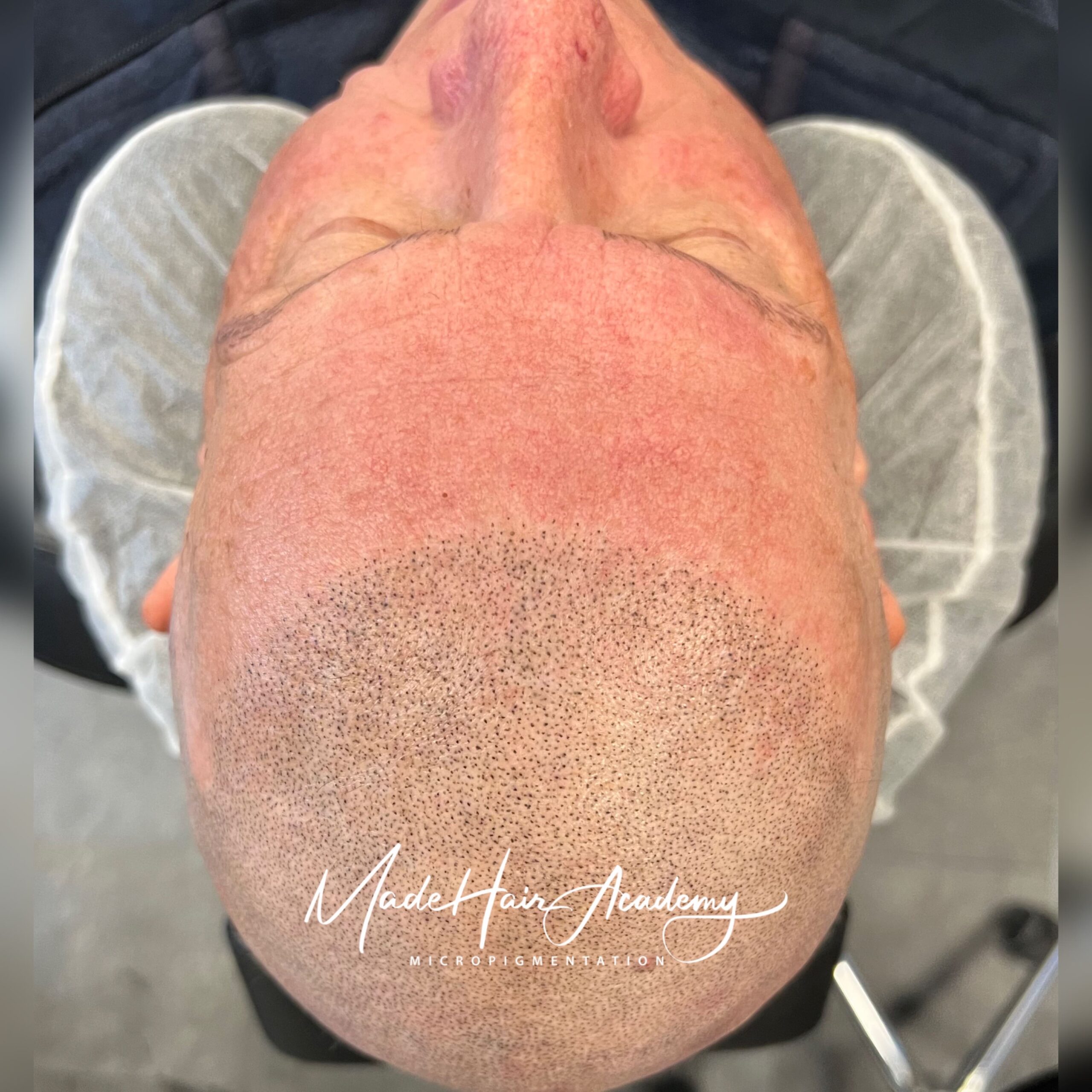 Made hair academy - Alopecia Behandling