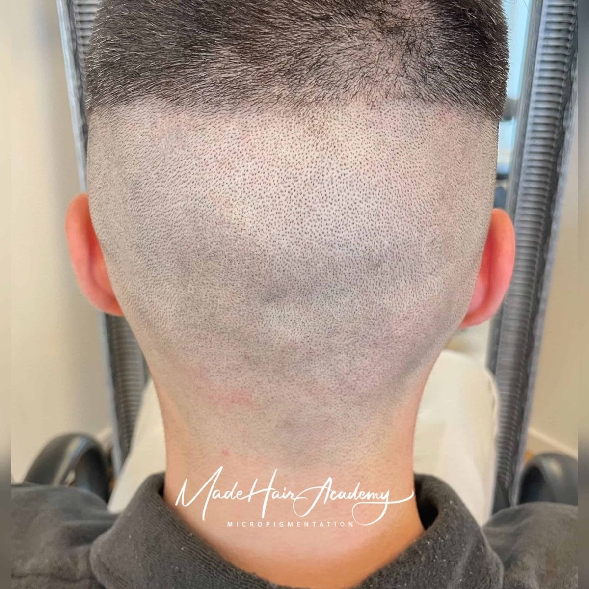 SMP prickpigmentering på man, 27 år, utförd hos Made Hair Academy i Göteborg – ledande klinik för diskret hårtatuering i Sverige