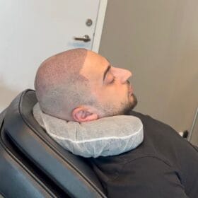 Resultat efter hårtransplantation förstärkt med hårpigmentering | Made Hair Academy – ledande i Sverige