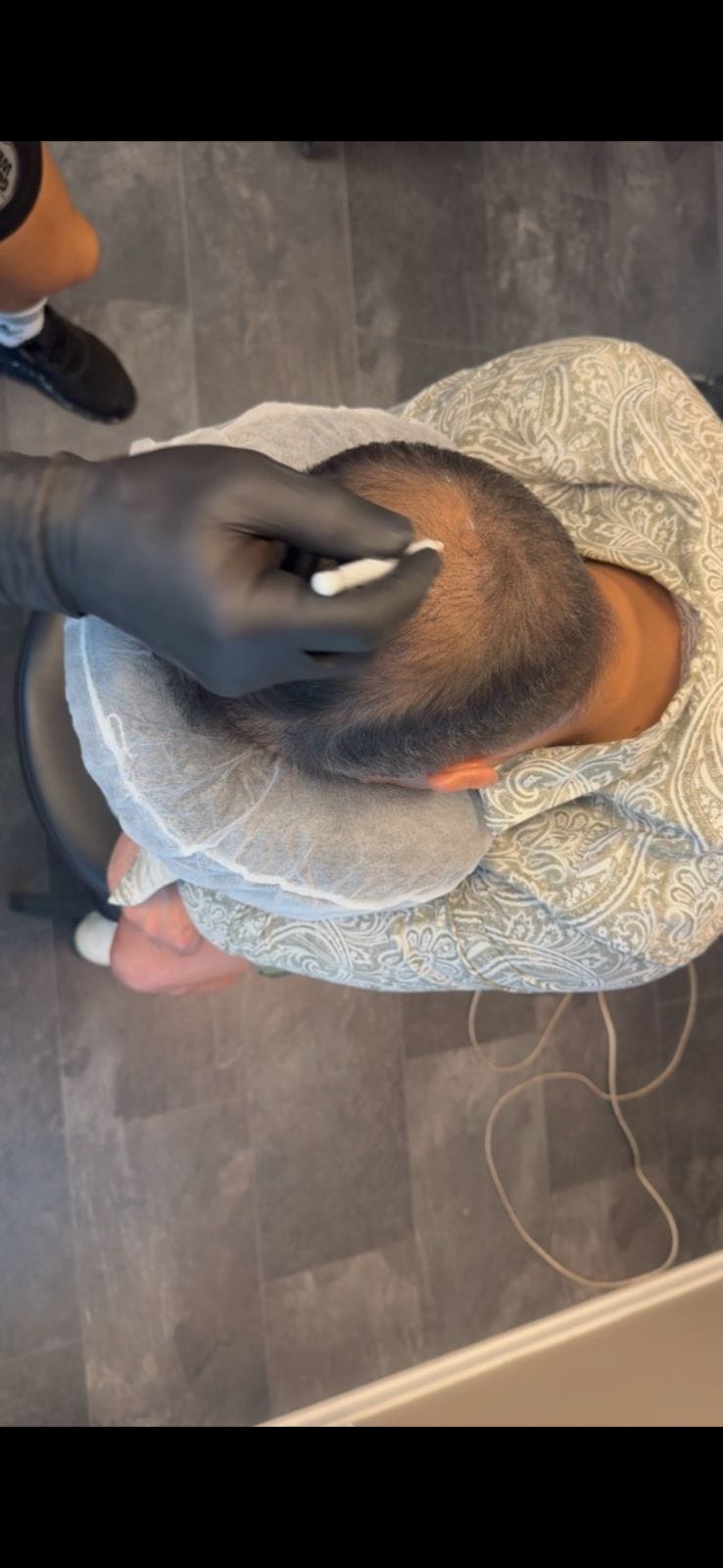 Exempel på mindre behandlingsområde inför scalp micropigmentation