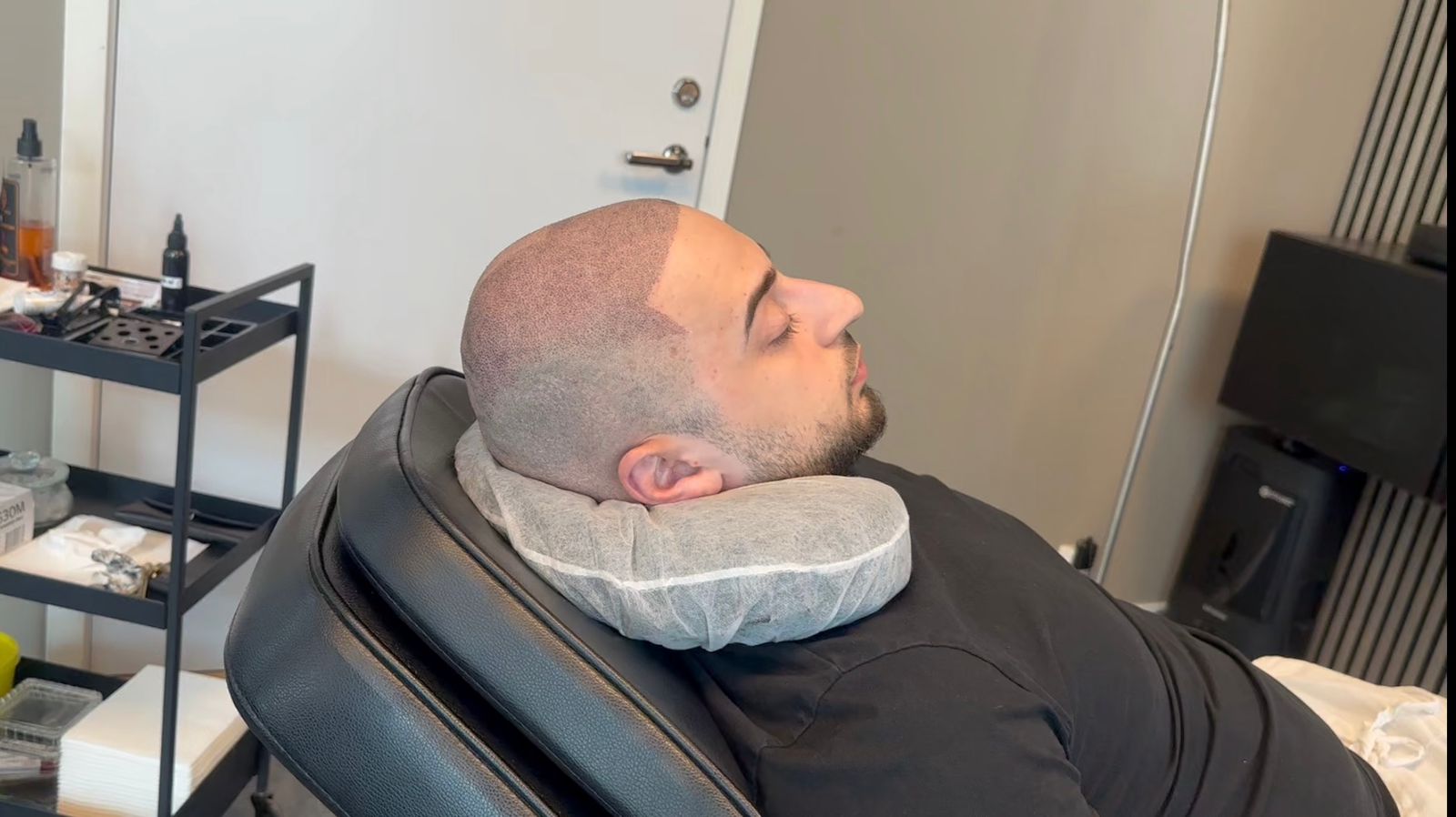 Resultat efter hårtransplantation förstärkt med hårpigmentering | Made Hair Academy – ledande i Sverige