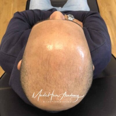 Harbotten-tatuering för man hårbotten i Stockholm utförd hos Made Hair Academy – ledande klinik inom hårpigmentering i Sverige