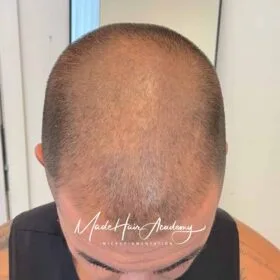 SMP Stockholm Hårlinje-pigmentering på man, 33 år, utförd hos Made Hair Academy i Göteborg – ledande klinik för diskret hårtatuering i Sverige om oss