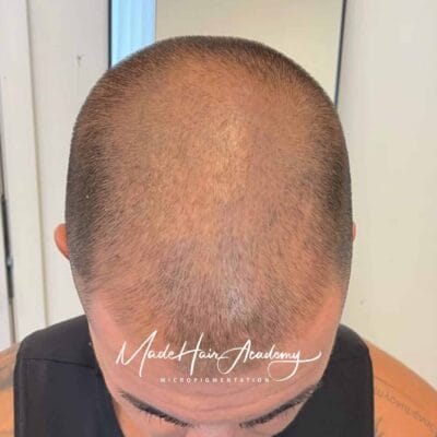 SMP Stockholm Hårlinje-pigmentering på man, 33 år, utförd hos Made Hair Academy i Göteborg – ledande klinik för diskret hårtatuering i Sverige om oss