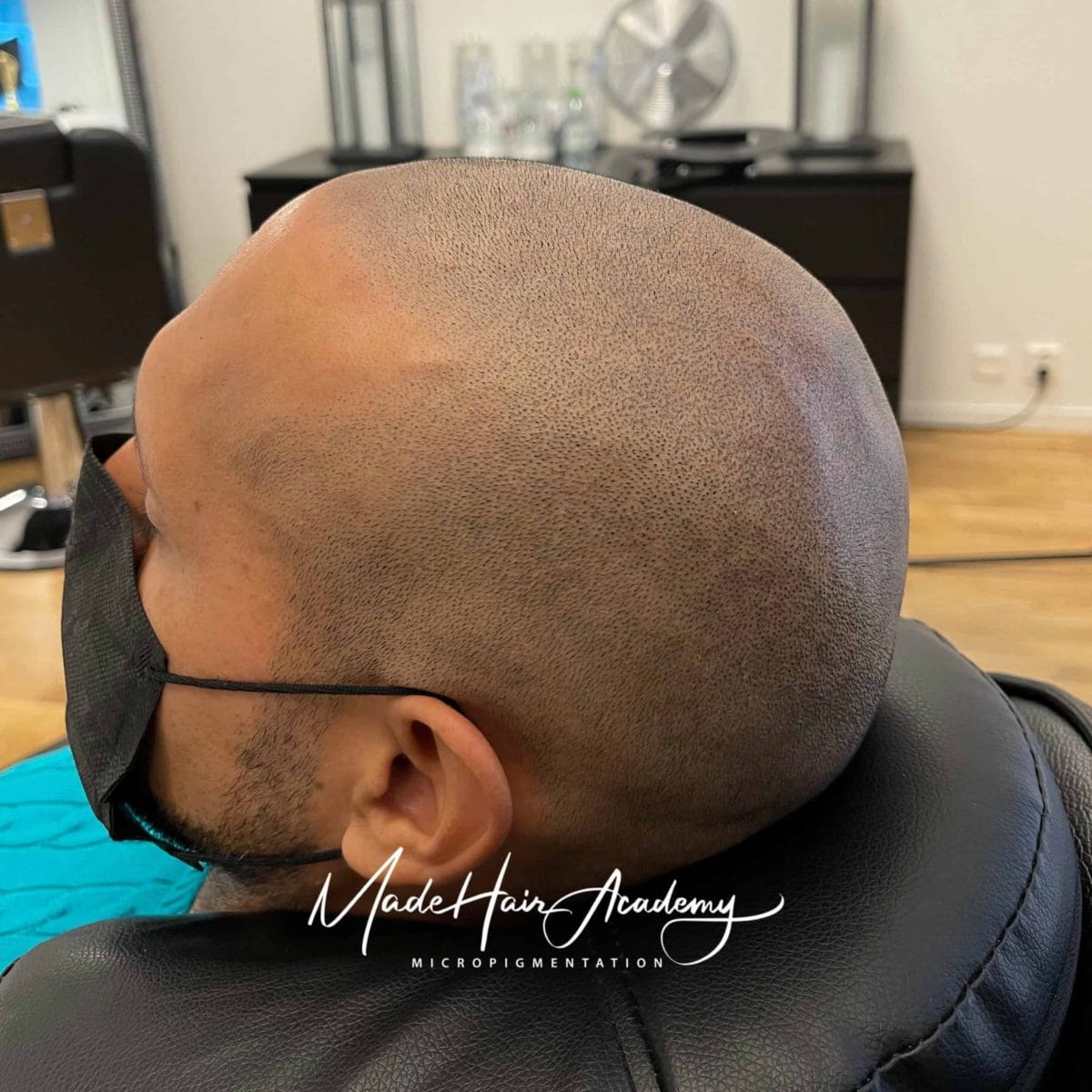 Scalp Micropigmentation - Med naturlig hårlinje med smp på man, 37 år, i Göteborg – Naturligt resultat från Made Hair Academy.