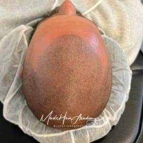 Scalp Micropigmentation, Hårpigmentering - Naturlig hårlinje med smp på man, 28 år, i Göteborg – Naturligt resultat från Made Hair Academy.