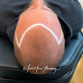 Hårpigmentering efter hårtransplantation. Scalp Micropigmentation, Hårpigmentering - Naturlig hårlinje med smp på man, 28 år, i Göteborg – Naturligt resultat från Made Hair Academy.