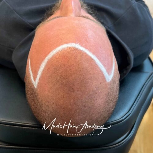 Scalp Micropigmentation, Hårpigmentering - Naturlig hårlinje med smp på man, 28 år, i Göteborg – Naturligt resultat från Made Hair Academy.