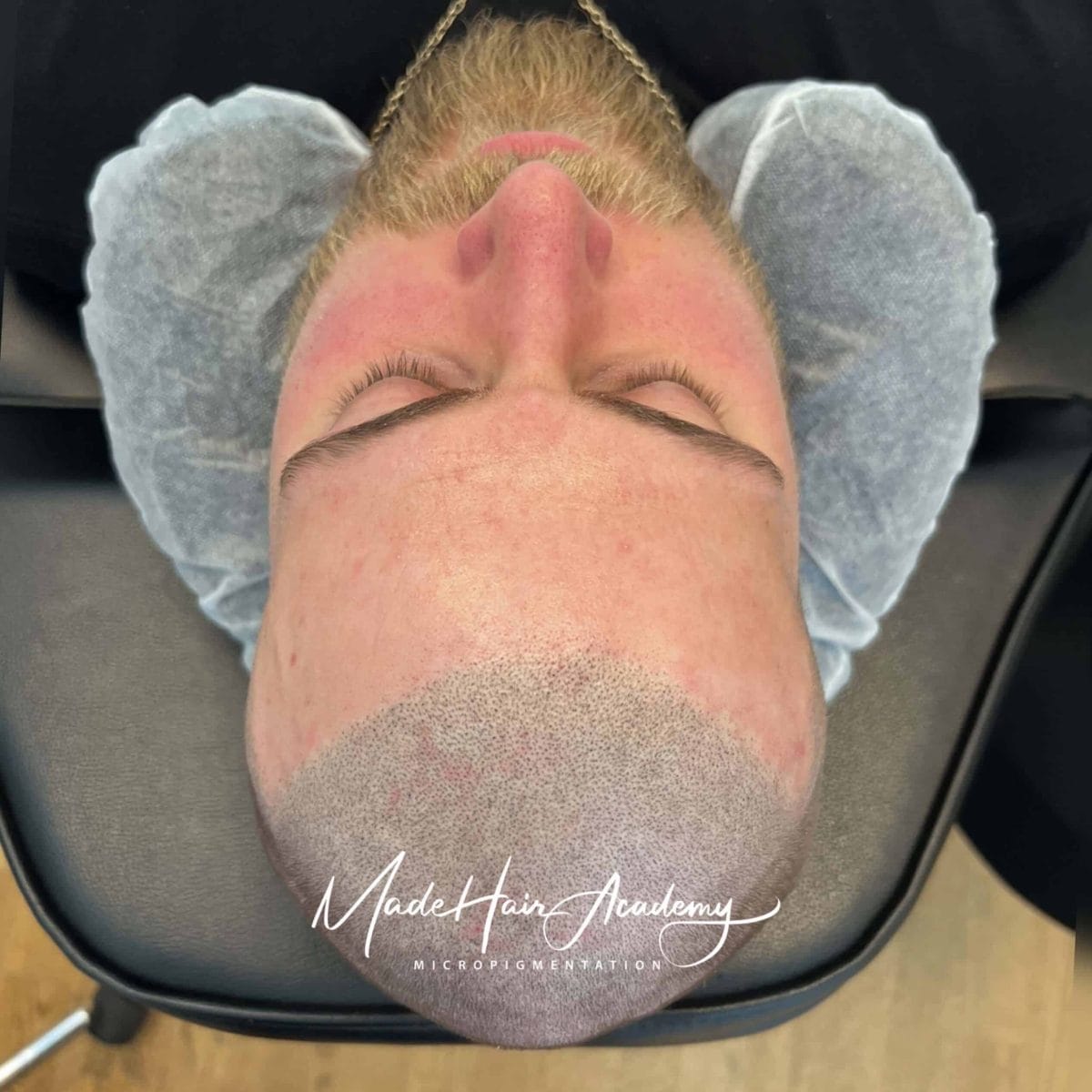 Scalp micropigmentering för man 38år i Stockholm utförd hos Made Hair Academy – ledande klinik inom hårpigmentering i Sverige