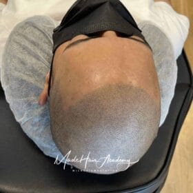 Skalp pigmentering för man 29 år i Göteborg utförd hos Made Hair Academy – ledande klinik inom hårpigmentering i Sverige