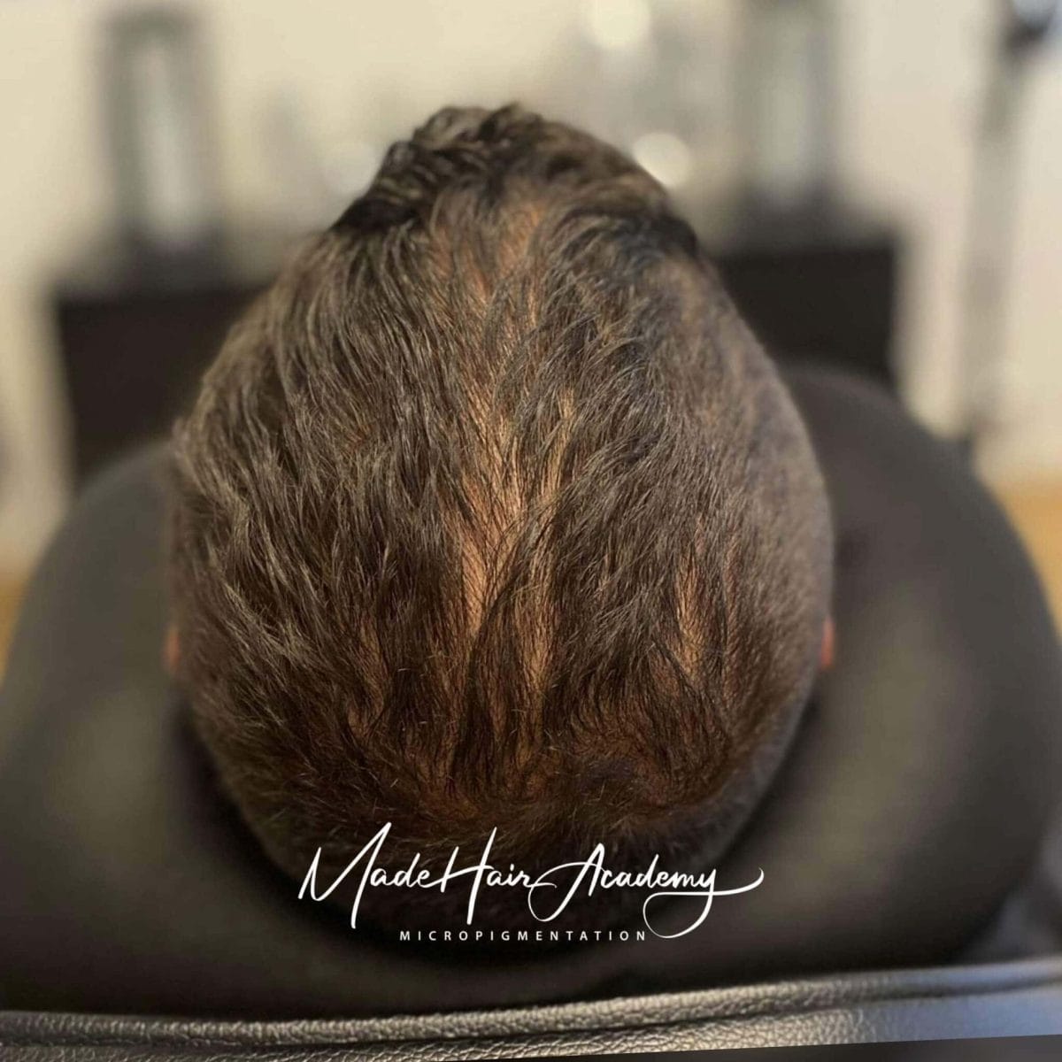 Före hårpigmentering - tunnhårig man Göteborg | Made Hair Academy ledande klinik i Sverige Skalp-pigmentering på man, 33 år, utförd hos Made Hair Academy i Stockholm – ledande klinik inom hårpigmentering i Sverige