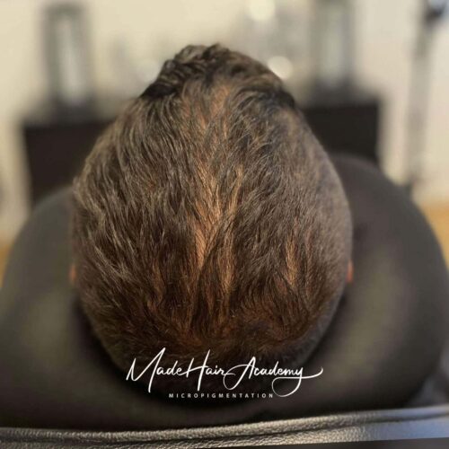 Före hårpigmentering - tunnhårig man Göteborg | Made Hair Academy ledande klinik i Sverige Skalp-pigmentering på man, 33 år, utförd hos Made Hair Academy i Stockholm – ledande klinik inom hårpigmentering i Sverige
