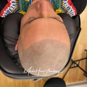 Skalp pigmentering på man, 36 år, utförd hos Made Hair Academy i Göteborg – ledande klinik för diskret hårtatuering i Sverige