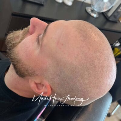 Hårpigmentering håravfall i Göteborg och Stockholm - naturlig behandling för tätare hår hos ledande klinik i Sverige SMP behandling på man, 28 år, utförd hos Made Hair Academy i Stockholm – ledande klinik för diskret hårtatuering i Sverige