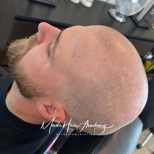 Hårpigmentering vid håravfall i Göteborg och Stockholm - naturlig behandling för tätare hår hos ledande klinik i Sverige SMP behandling på man, 28 år, utförd hos Made Hair Academy i Stockholm – ledande klinik för diskret hårtatuering i Sverige