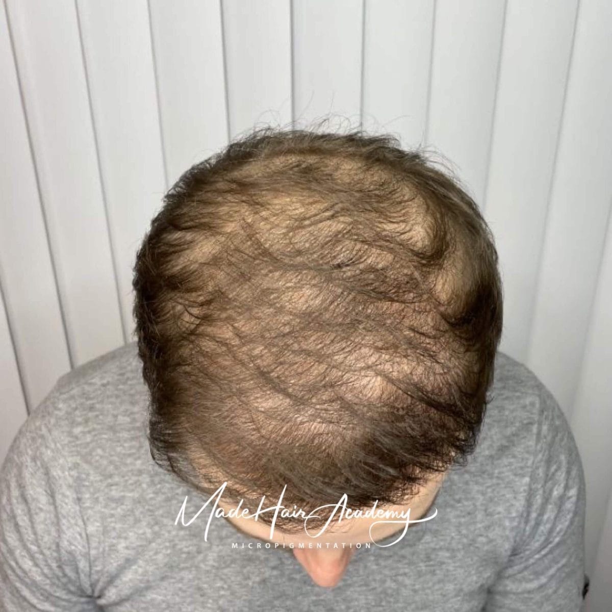 Hårtransplantation Göteborg Scalp micropigmentering på man, 33 år, utförd hos Made Hair Academy i Göteborg – ledande klinik inom hårpigmentering i Sverige