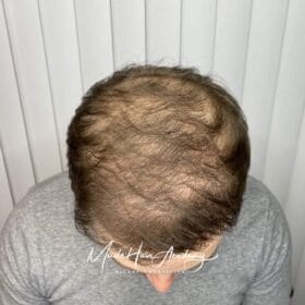 SMP Göteborg hårpigmentering mot tunnhårighet. Hårtransplantation Göteborg Scalp micropigmentering på man, 33 år, utförd hos Made Hair Academy i Göteborg – ledande klinik inom hårpigmentering i Sverige om oss