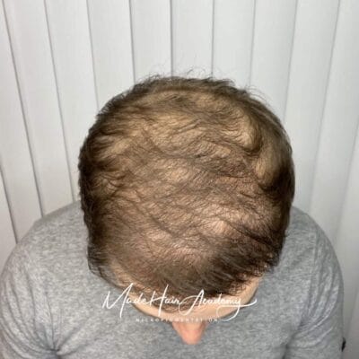 SMP Göteborg hårpigmentering mot tunnhårighet. Hårtransplantation Göteborg Scalp micropigmentering på man, 33 år, utförd hos Made Hair Academy i Göteborg – ledande klinik inom hårpigmentering i Sverige om oss