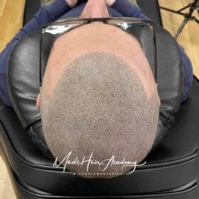 SMP Göteborg. SMP hårlinje på man, 41 år, utförd hos Made Hair Academy i Göteborg – ledande klinik för diskret hårtatuering i Sverige