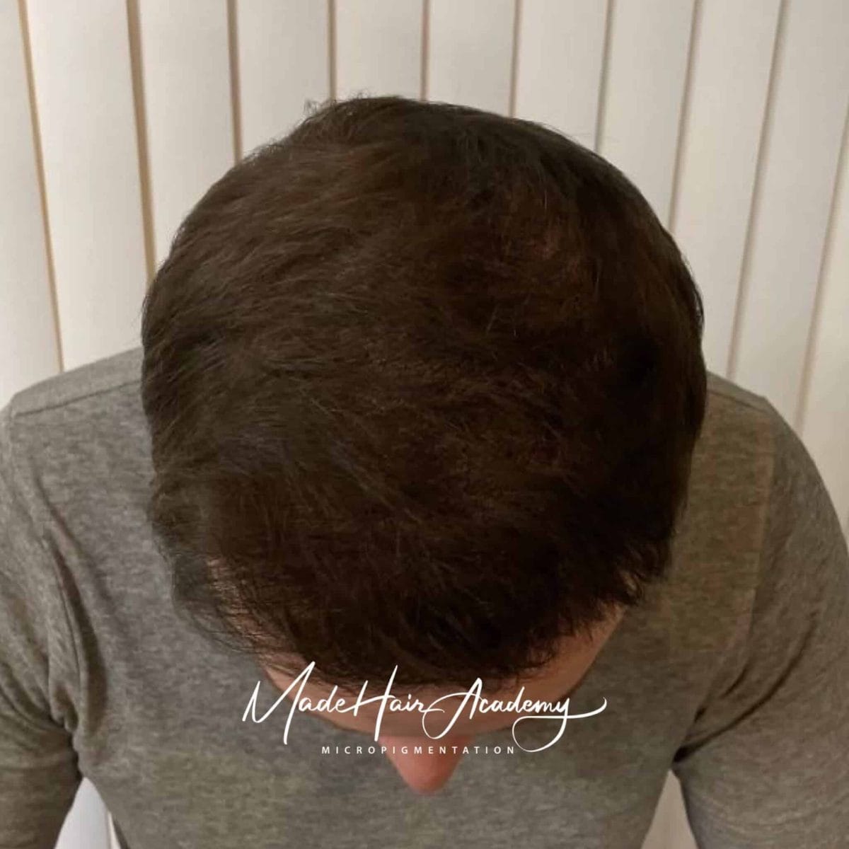 SMP-behandling av hårlinje på man, 42 år, utförd hos Made Hair Academy i Göteborg – ledande klinik för diskret hårtatuering i Sverige