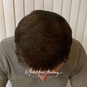 SMP Göteborg SMP-behandling av hårlinje på man, 42 år, utförd hos Made Hair Academy i Göteborg – ledande klinik för diskret hårtatuering i Sverige om oss