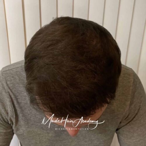 SMP-behandling av hårlinje på man, 42 år, utförd hos Made Hair Academy i Göteborg – ledande klinik för diskret hårtatuering i Sverige