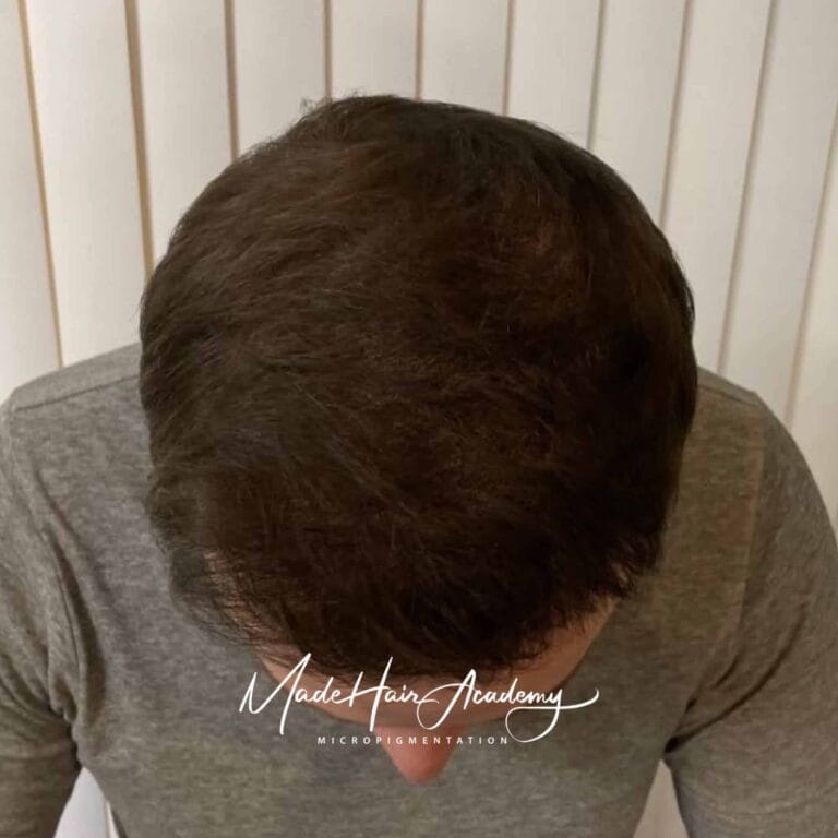 SMP-behandling av hårlinje på man, 42 år, utförd hos Made Hair Academy i Göteborg – ledande klinik för diskret hårtatuering i Sverige