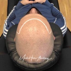 SMP Göteborg Diskret hårfyllnad för tunnhårig man, 28 år, utförd hos Made Hair Academy i Stockholm – ledande klinik för diskret hårtatuering i Sverige